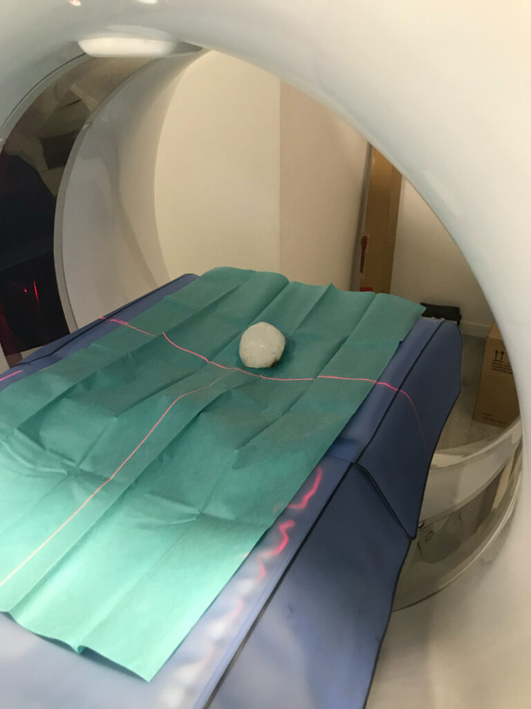 A giant hailstone sits on a green towel inside a CT scan machine.