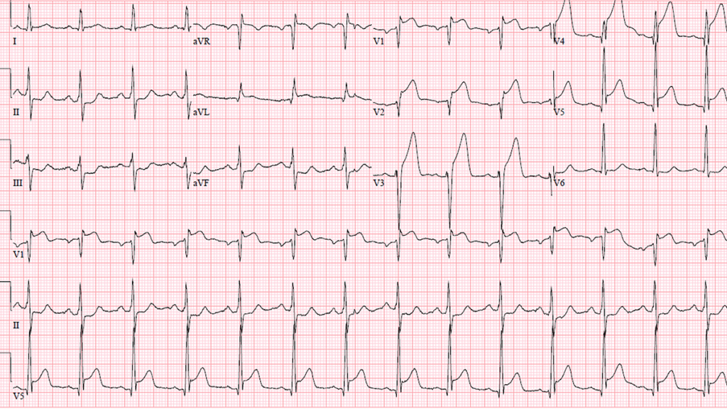 Electrocardiogram demonstrating a major myocardial infarction